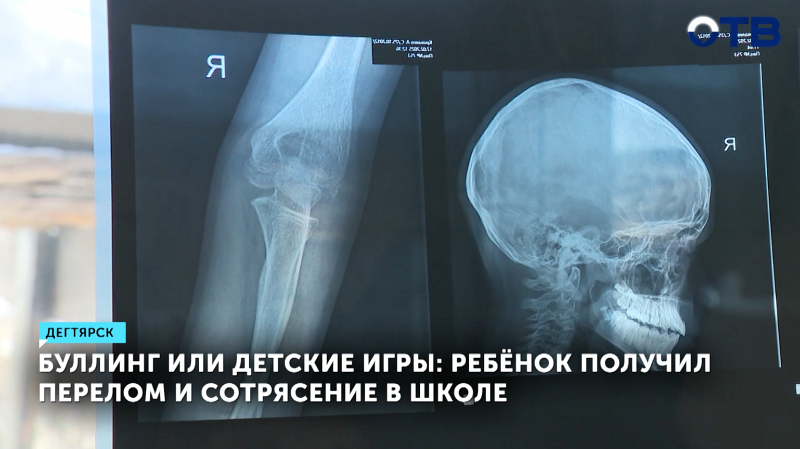 12-летний мальчик из Дегтярска стал жертвой буллинга в школе