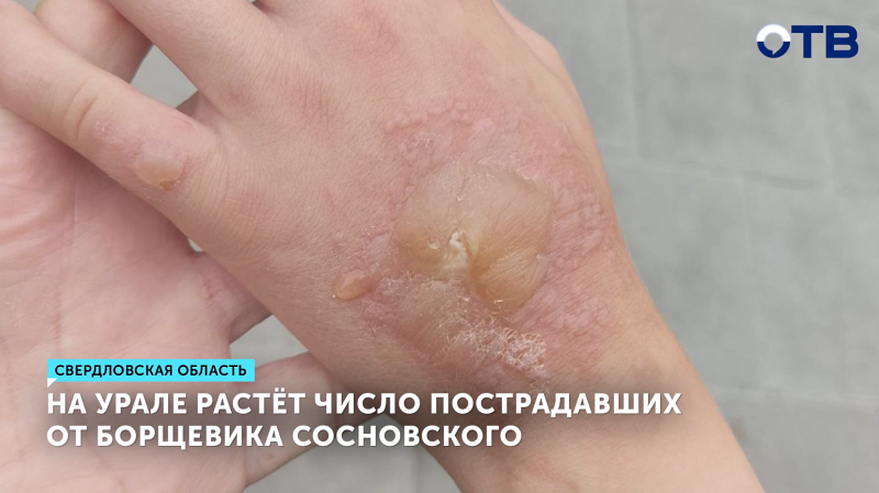 Уральцы всё чаще страдают от ожогов борщевика Сосновского