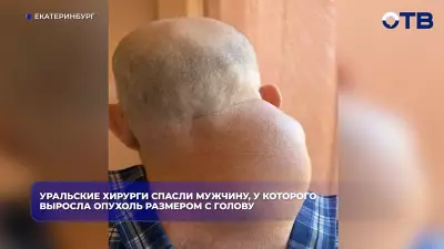 Хирурги Екатеринбурга удалили мужчине опухоль весом 2 кг