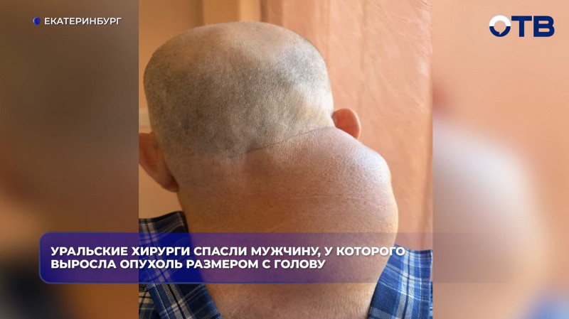 Хирурги Екатеринбурга удалили мужчине опухоль весом 2 кг