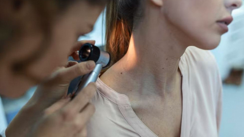 Пора бить тревогу? Как распознать опасную родинку