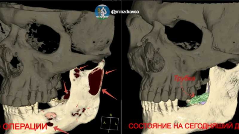Челюсть свердловчанина спасли от разъедавшей её кисты