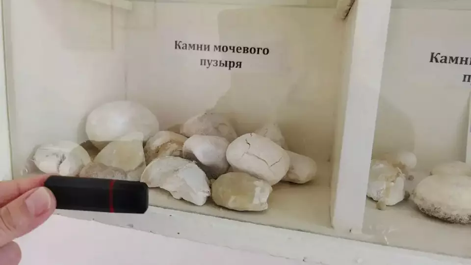 Свердловские врачи удаляют камни в почках за 30 минут без разрезов с помощью нового российского лазера