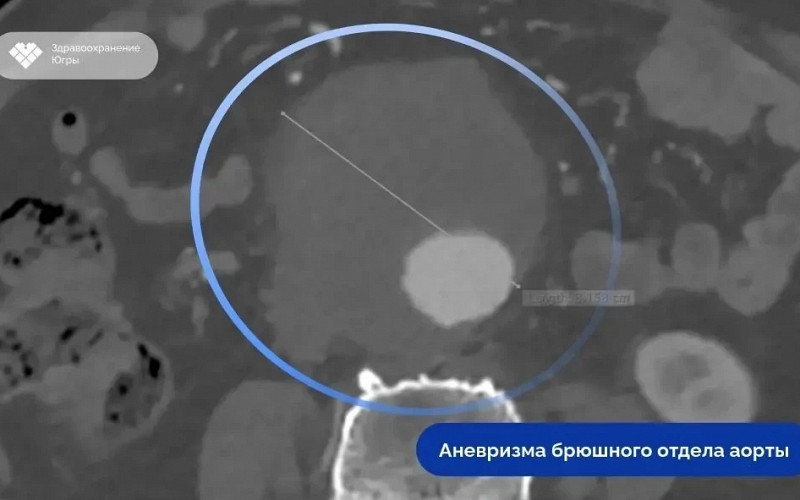Врачи восстановили аорту 75-летнего пациента из пяти компонентов протеза